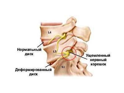 Ишиас седалищного нерва