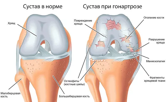 Остеопороз: симптомы и лечение. Профилактика и диагностика остеопороза суставов.