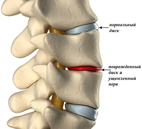 Аритмия при остеохондрозе. Какие симптомы? - Prima-Vertebra