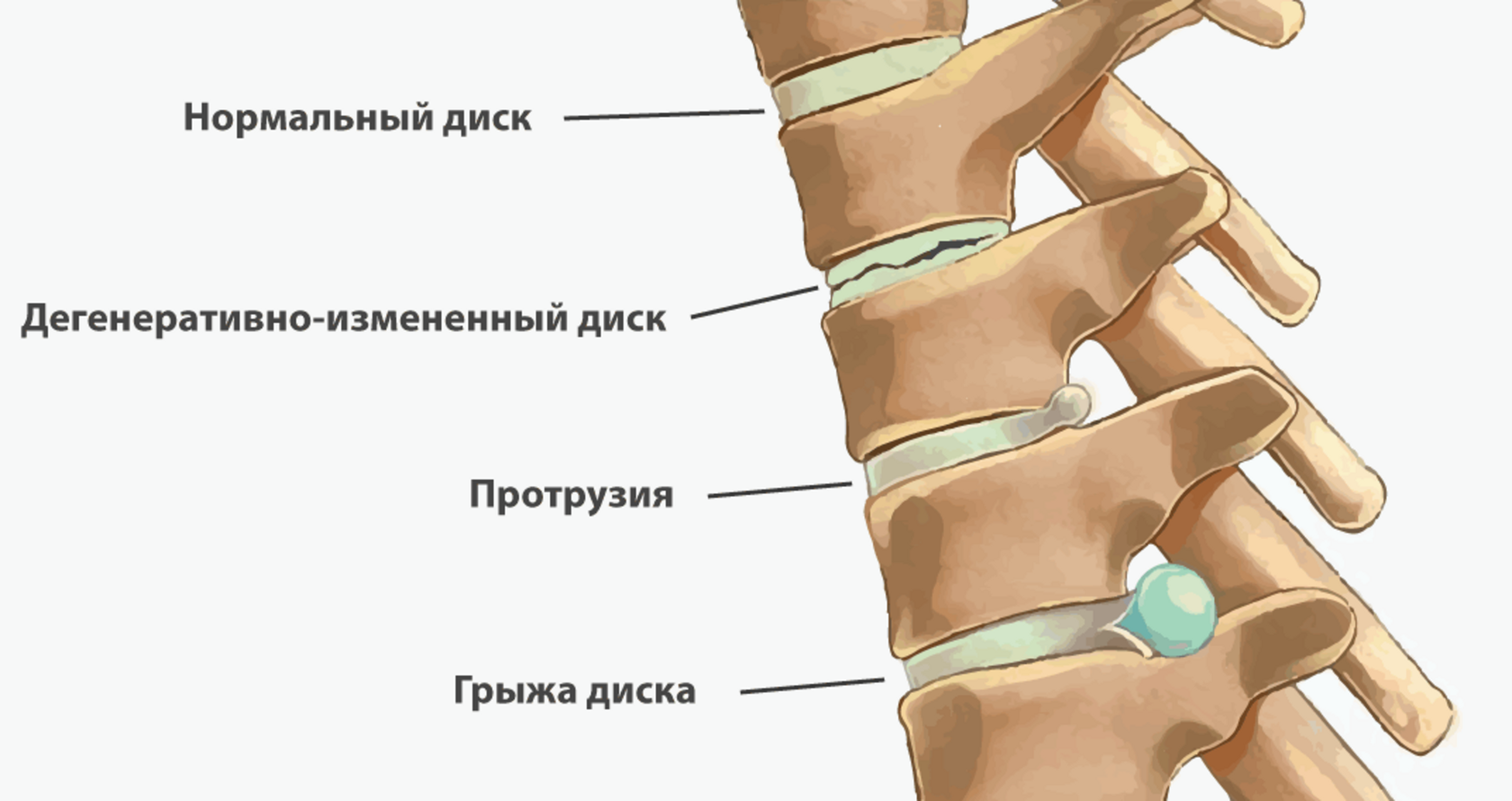 Протрузия поясничного отдела позвоночника — симптомы и лечение | Клиника  Temed