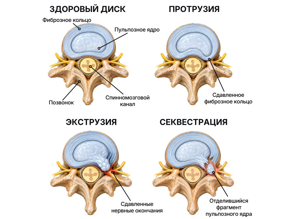 Изменения межпозвонкового диска