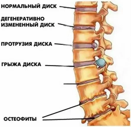 Лечение спондилёза грудного отдела позвоночника в Москве - Центр ортопедии профессора Сампиева
