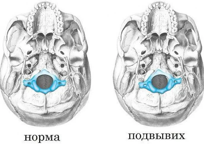 Родовая травма шейного отдела позвоночника